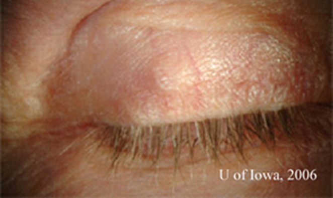 sebasceous gland carcinoma