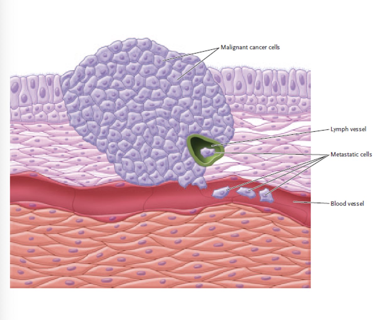 <p><span>Tumours that are<strong> not </strong>encapsulated and are <strong>invasive.</strong></span></p>