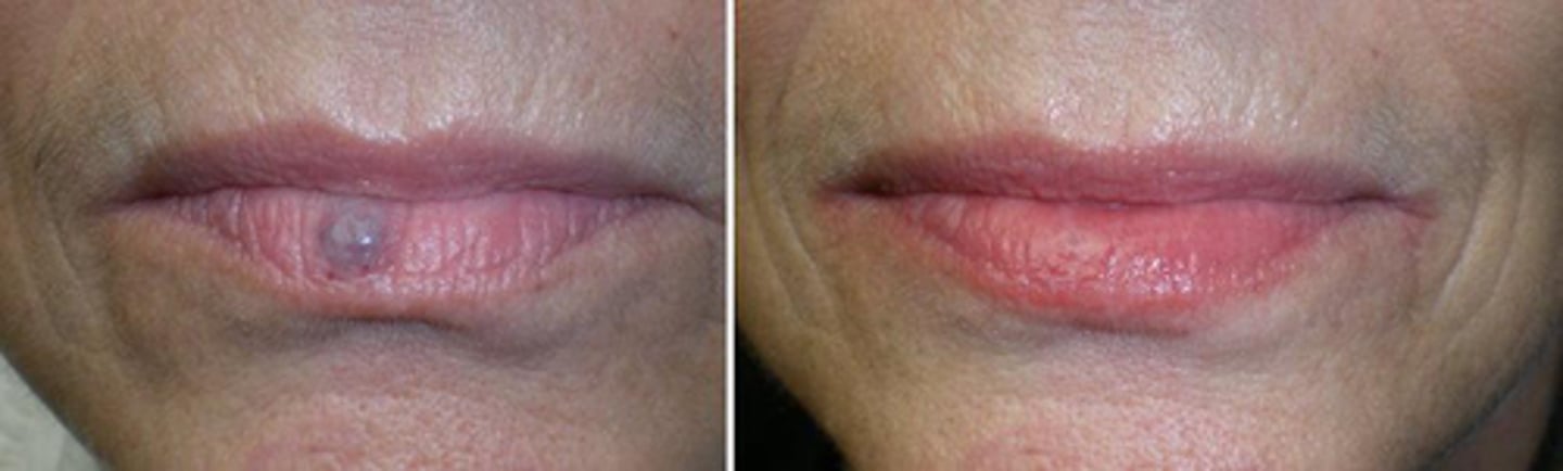 <p>a blue lesion that appears on the lower lip, pt states it has been present from birth. what is the lesion?</p><p>a. hematoma</p><p>b. hemangioma</p><p>c. mucocele</p><p>d. fibroma</p>