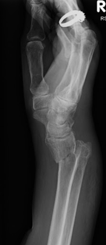 <p>flexion fracture of radius (displaced anteriorly)</p>