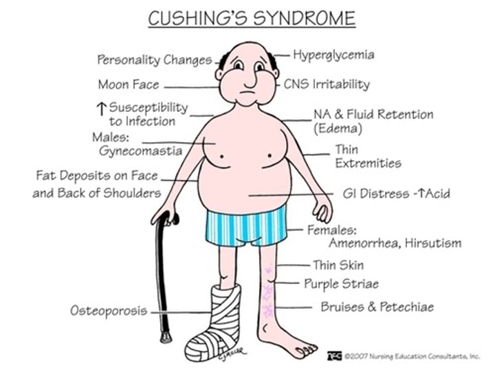 <p>Cushing's Syndrome</p>