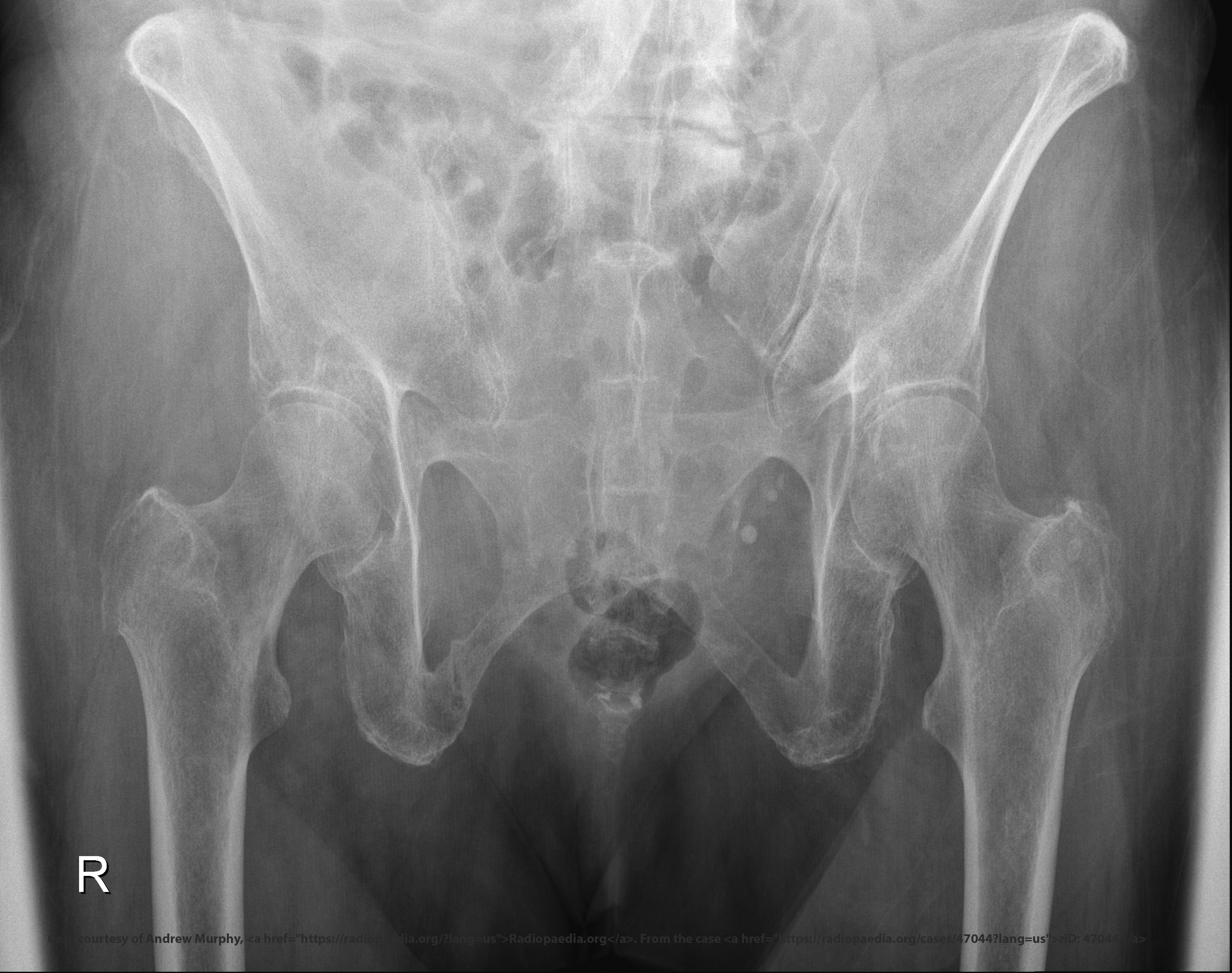 <p>Vertical displacement.</p>