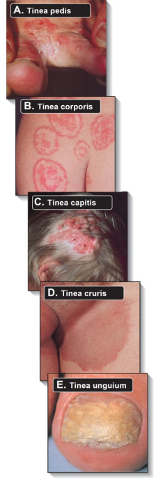 <p>Caused by <strong>dermatophytes</strong> (ringworm), termed ‘tinea’ by site: Tinea <strong>pedis</strong> (feet, “athlete’s foot”) , Tinea <strong>corporis</strong> (body, “ringworm”) , Tinea <strong>capitis</strong> (head) , Tinea <strong>cruris</strong> (crotch, “jock itch”) , Tinea <strong>unguium</strong> (nails, onychomycosis)<br>Dermatophytes not part of normal skin flora, found in <strong>soil</strong> or <strong>animals</strong> , survive in <strong>wet locations</strong><br>Genera include <strong>Microsporum</strong> , <strong>Trichophyton</strong> , <strong>Epidermophyton</strong> ; most will not grow at <strong>37°C</strong></p>