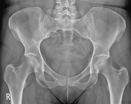 <p>ischial spines</p>