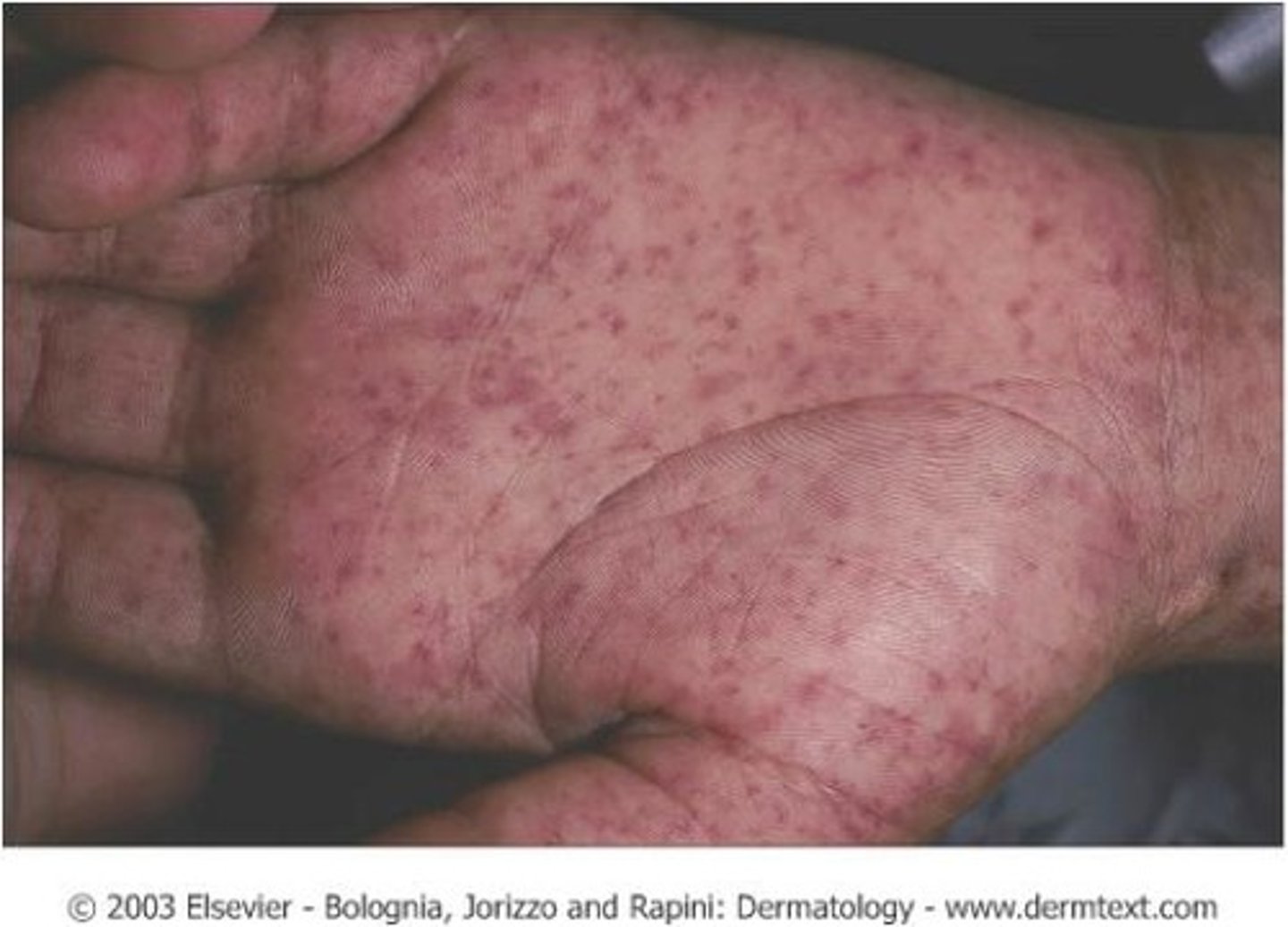<p>Rocky Mountain Spotted Fever (RMSF)</p>