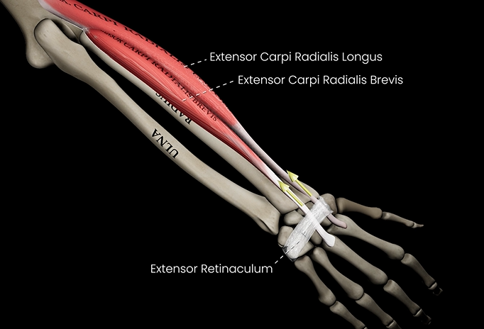 <p>Function: extends wrist</p><p>Origin: lateral epicondyle of humerus</p><p>Insertion: metacarpals</p>