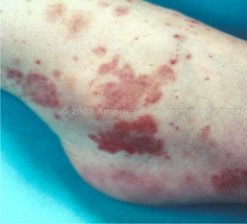 <p>larger red or purple discolorations on the skin, 3-10mm in size, caused by bleeding under the skin</p>