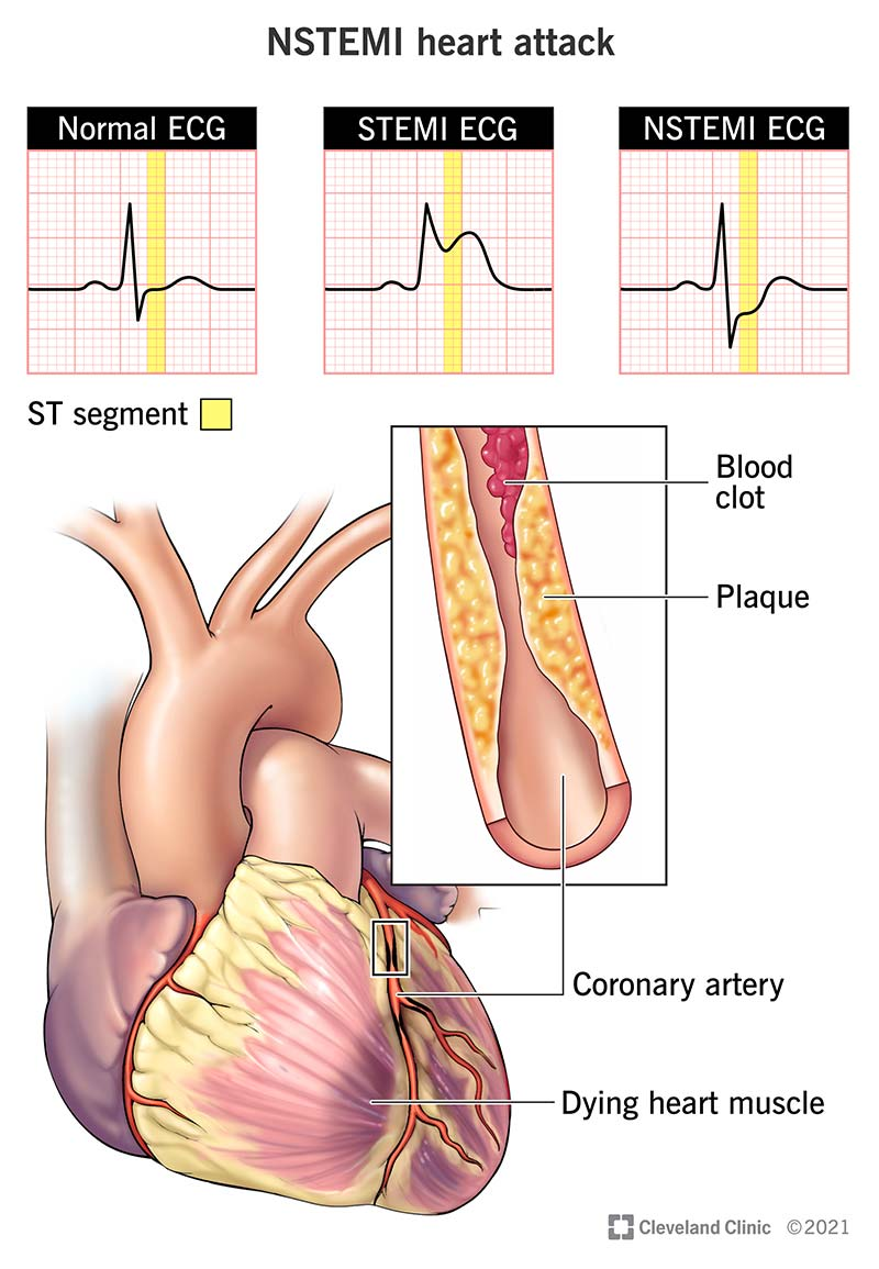 <p>By <strong>acute myocardial ischemia that leads to myocardial injury, </strong>typically due to a<strong> partial occlusion</strong> of a coronary artery.</p>