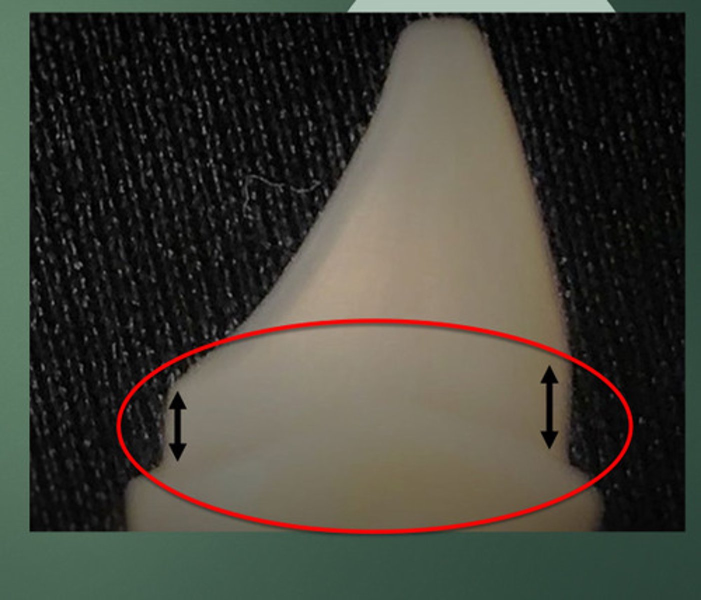 <p>A band (of tooth structure) that encircles the external dimension of tooth structure</p>
