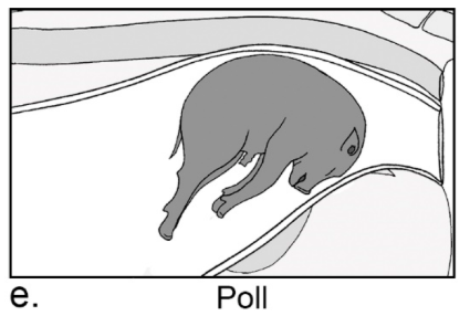 <p>When the foetus comes head-first but the neck is flexed, causing the top of the head to become lodged in the birth canal</p>