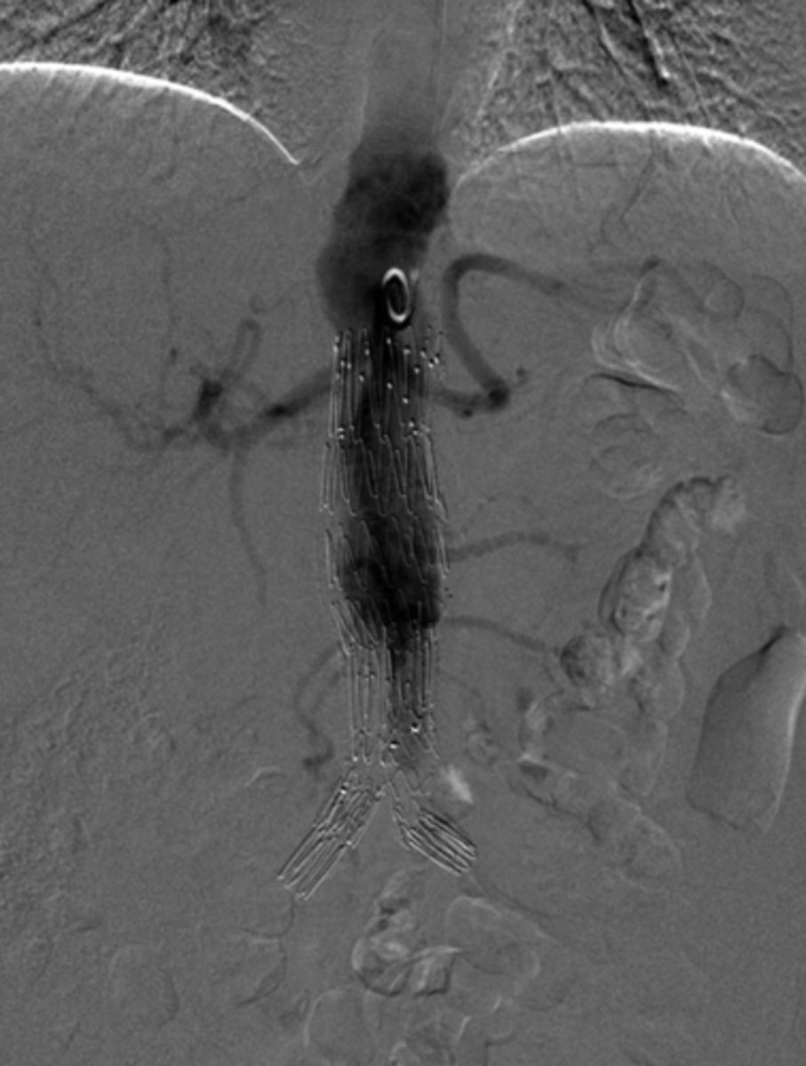 <p>Catheter access through CFA in groin</p><p>Device is anchored with stents in the normal aorta proximal &amp; distal to AAA</p>