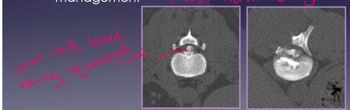 <ul><li><p>15-20% - on average but increases with mineralized disk in situ </p></li><li><p>50% risk with >5 mineralized disk <strong>IN SITU </strong></p></li><li><p>risk increases with inappropriate management - they can herniate again so 4-6 weeks rest important </p></li></ul><p></p>