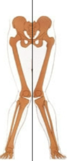 <p>distal segment (foot) deviates away from the midline relative to proximal segemnt </p>