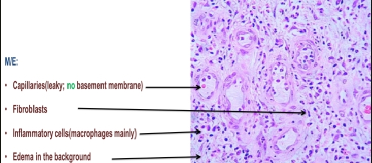<p>1-Capillaries(leaky; no basement membrane)</p><p>2-Fibroblasts</p><p>3-Inflammatory cells(macrophages mainly)</p><p>4-Edema in the background</p>