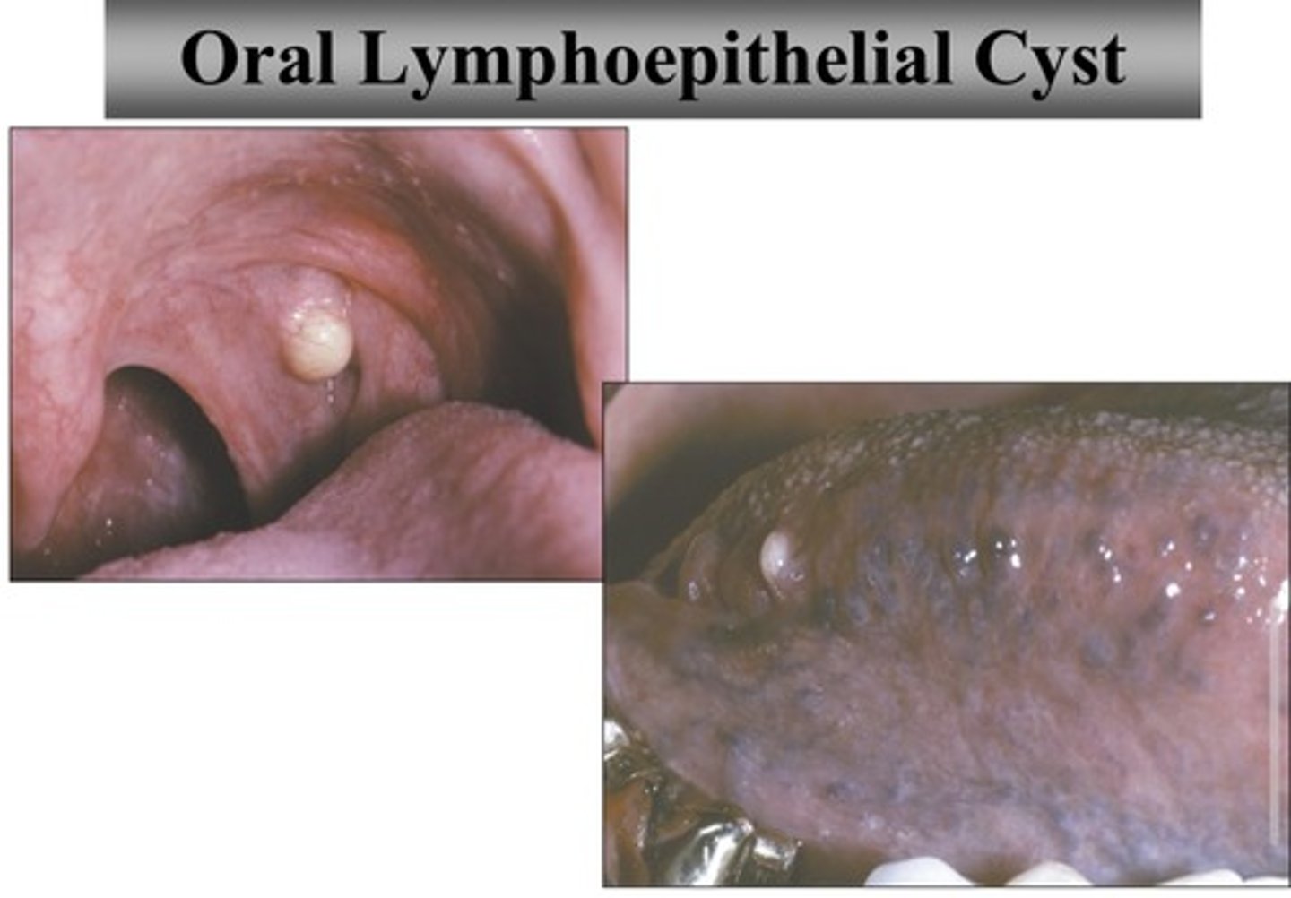 <p>oral lymphoepithelial cyst</p>
