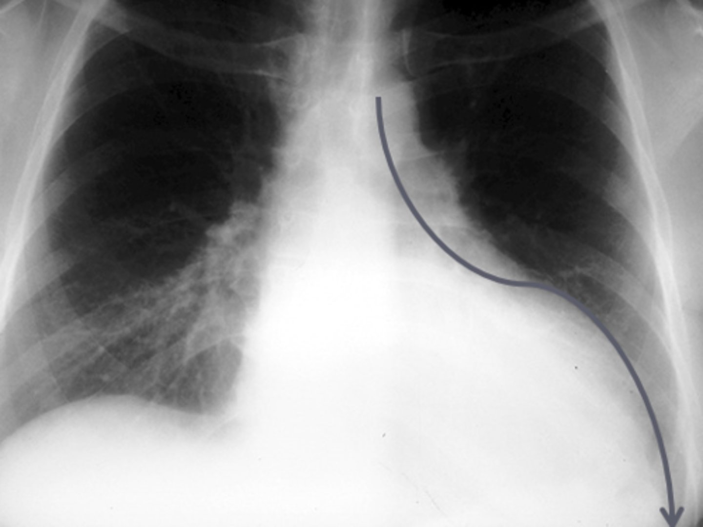 <p>notice how the enlarged heart follows the contour of the diaphragm down toward the CP angle</p><p>- "weenie dog" heart</p>