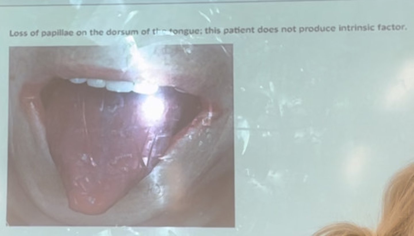 <p>Loss of papilla on the dorsum of the tongue; this patient does not produce intrinsic factor.</p>