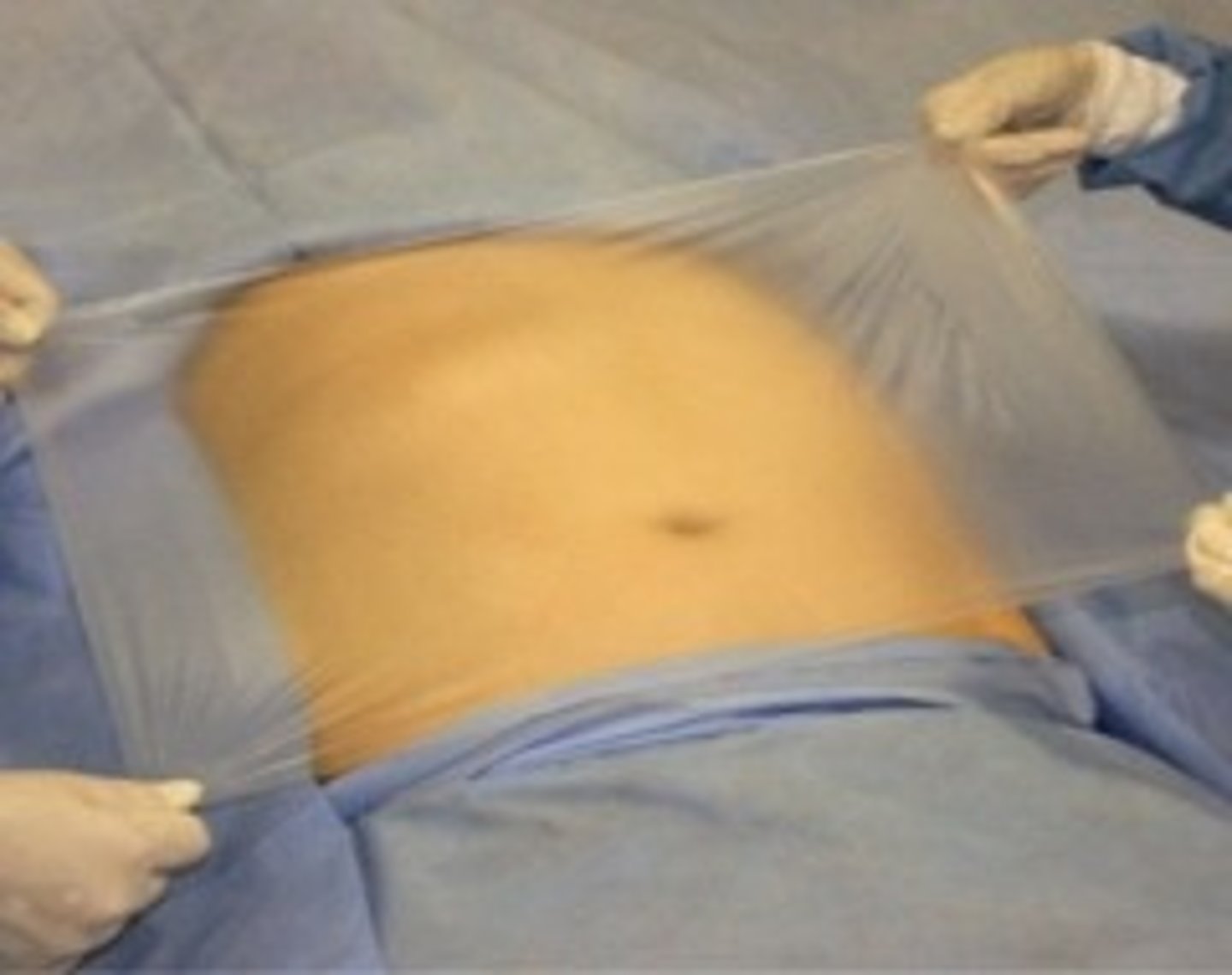 <p>applied to patients skin after squaring off incision site</p>