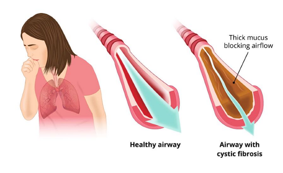 ● Autosomal recessive disorder 

● Mutation leads to a buildup of excessive mucus in the airways 

● Mucus leads to airway obstruction 