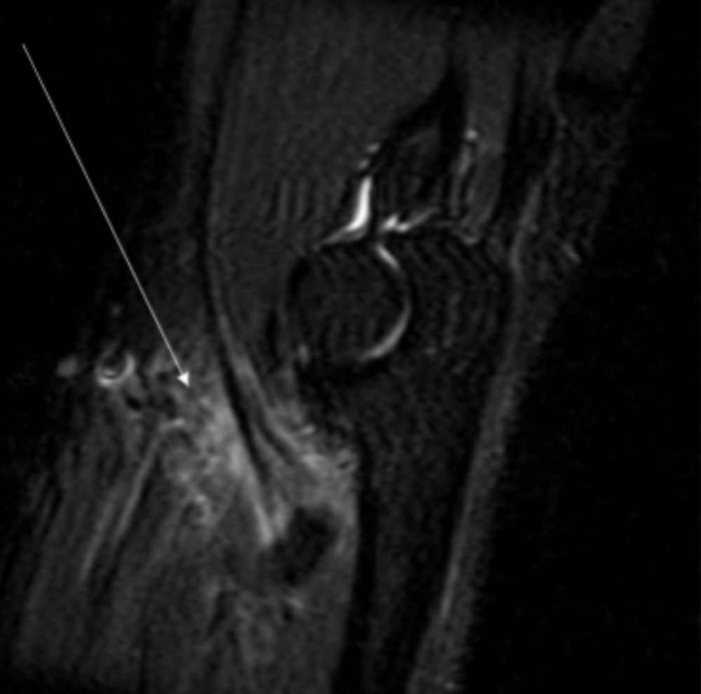 <p>Describe the pathology indicated by the arrow (Sag T2 FS).</p>