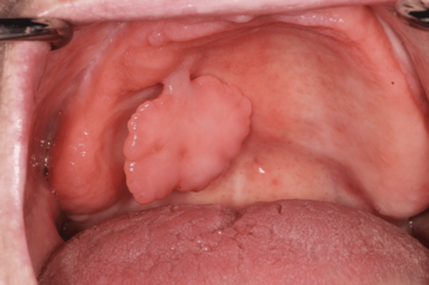 <p>denture-leaf fibroma</p>