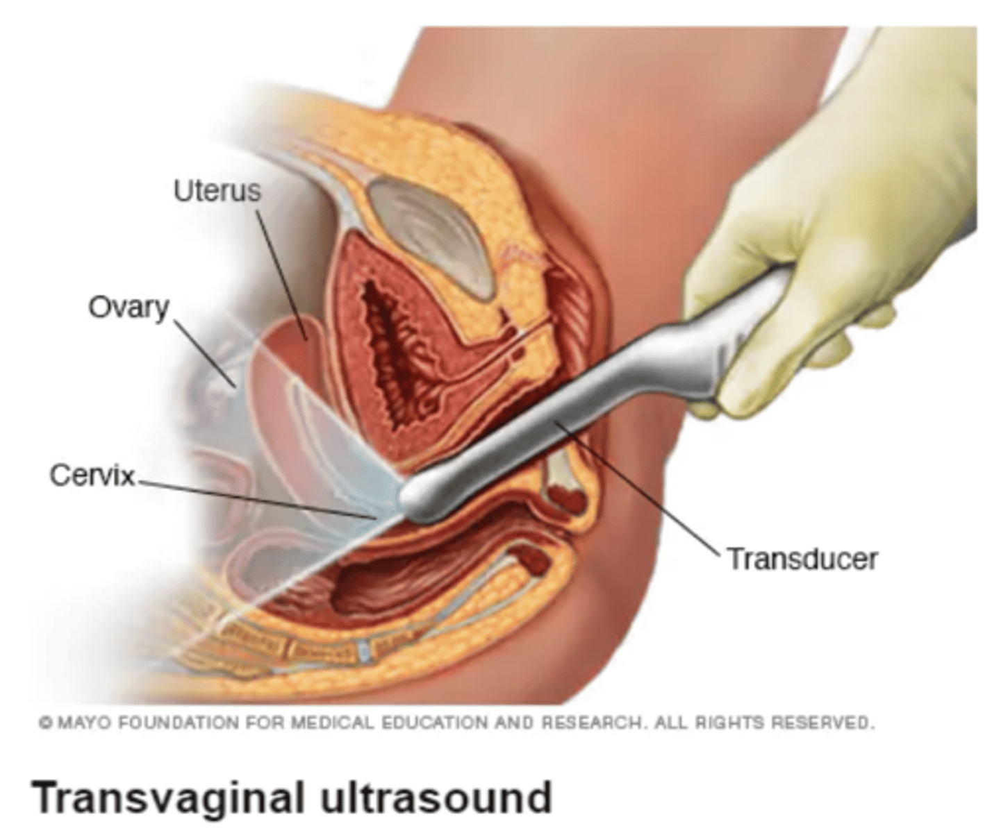 <p>- used to diagnose ectopic pregnancy in a stable pt</p><p>- transducer inserted into vagina + visualization of uterus, cervix, ovary, fallopian tubes</p><p>- presence or absence of an intrauterine gestational sac </p>