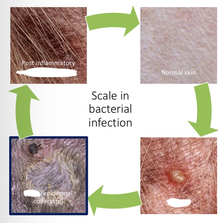 <p>Normal → pustule → scale, epidermal collarette → post infl hyperpigmentation </p>