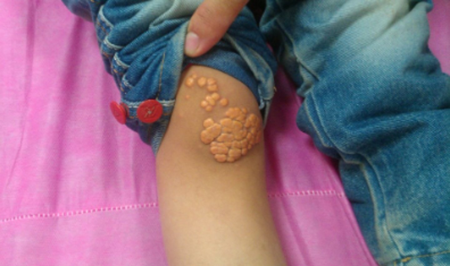 <p>collection of cholesterol</p><p>can show up on skin</p><p>associated with hyperlipidemia</p>