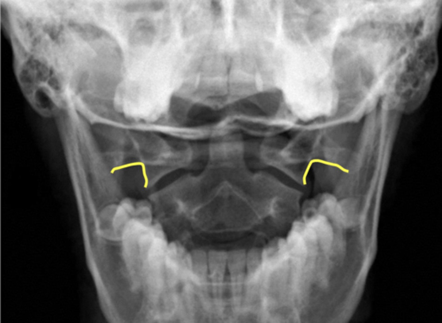 <p>What are outlined in yellow?</p>