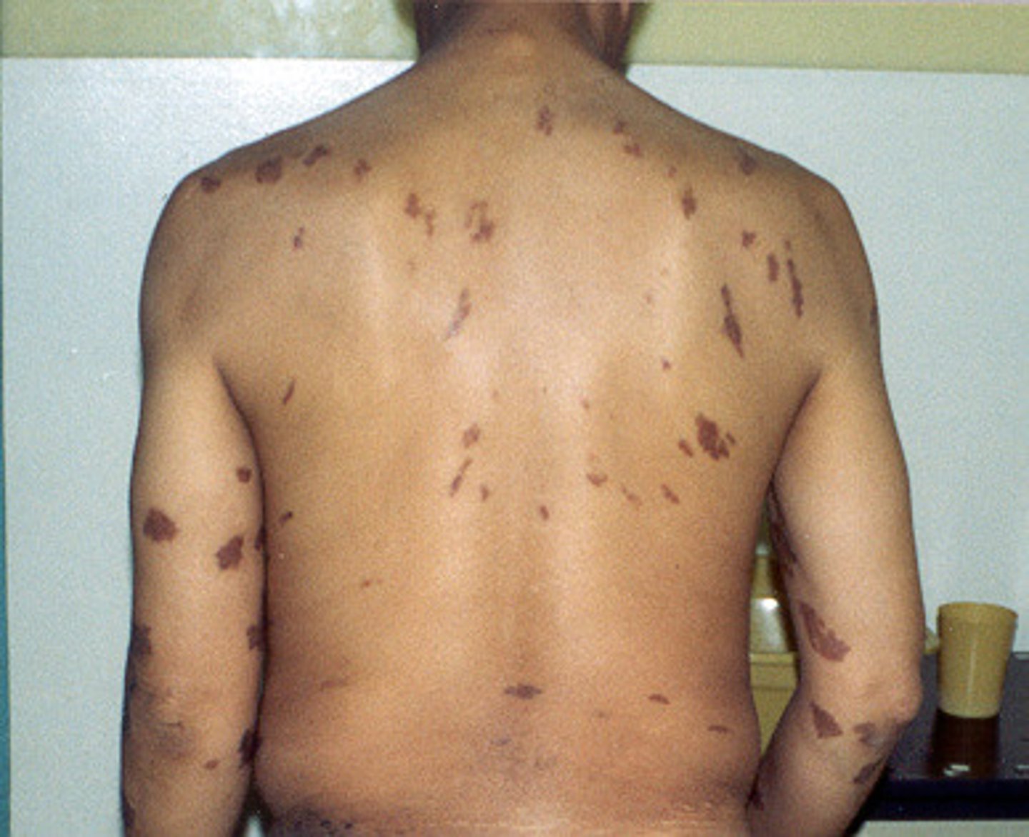 <p>painless purple lesions</p><p>legs, feet, and face</p><p>can occur in mucosal surface</p>