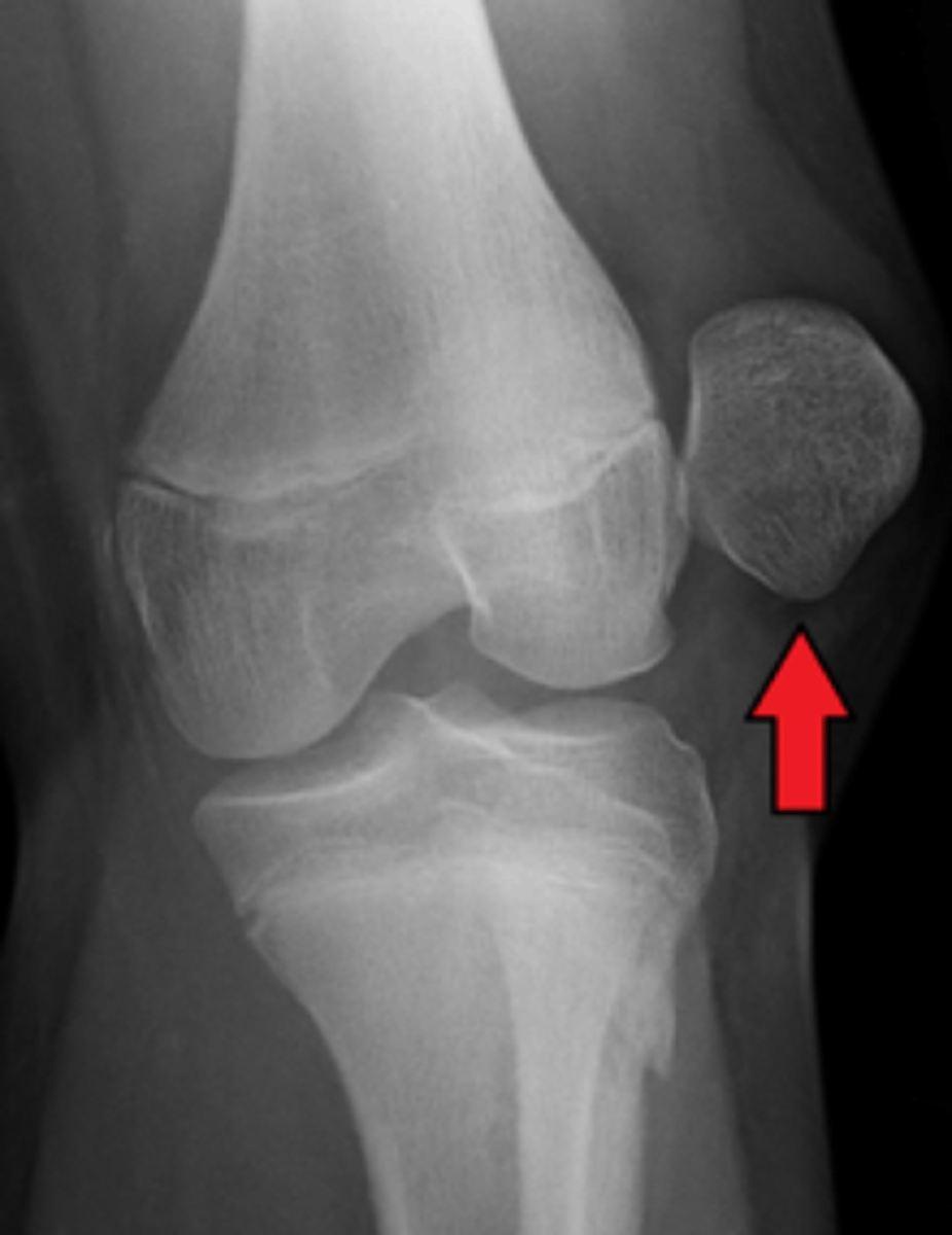 <p>athlete may have tight lateral tissue, weak VMO, or forced to outside by contact with another object</p>