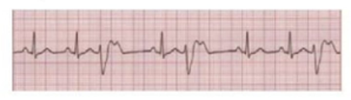 <p>A - PVC - check potassium</p>
