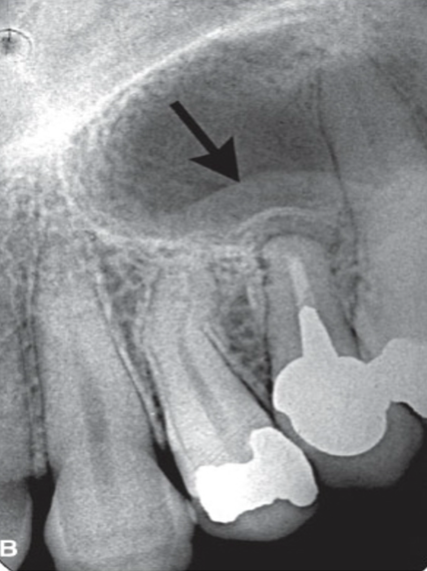<ul><li><p>reactive changes → remodeling of floor of maxillary sinus, with maxillary sinus mucosal thickening</p></li><li><p>dense, reactive bone formation → radiopacity around periapical lesions</p></li></ul><p></p>