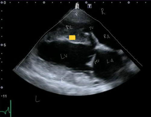 <p>Right Parasternal Long Axis View</p>