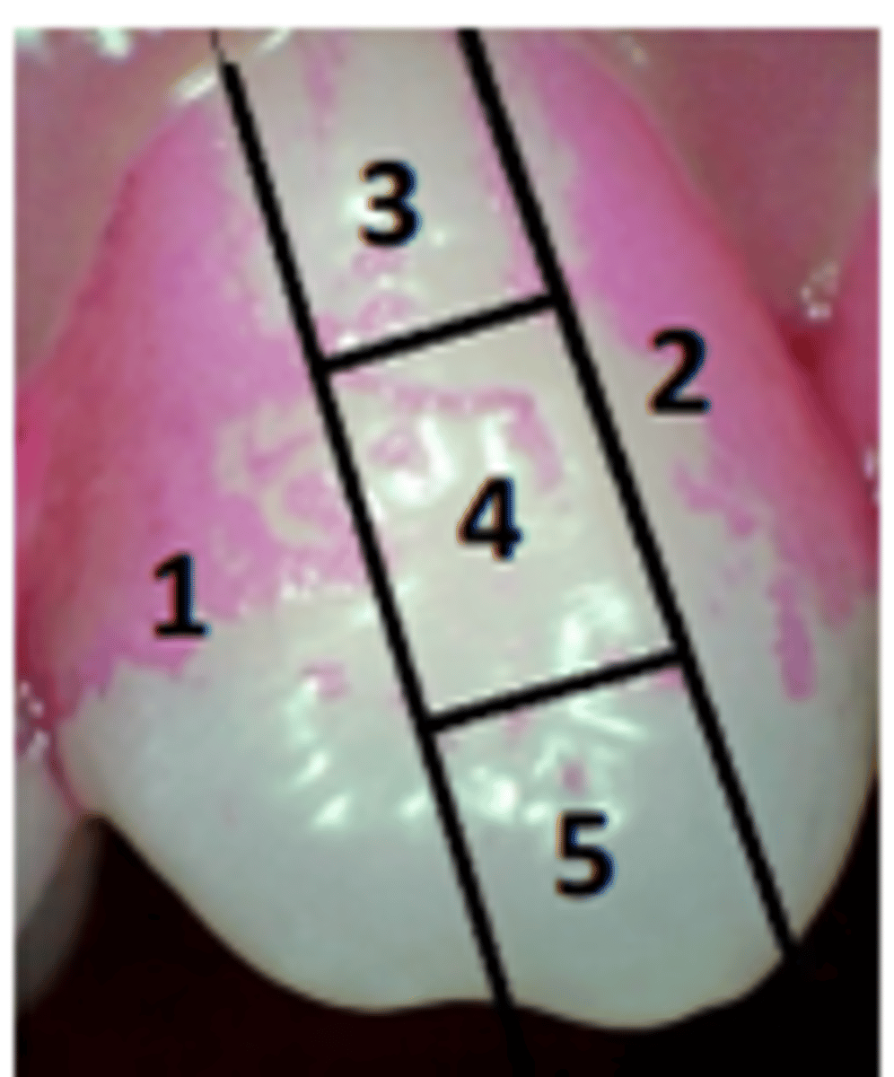 <p>-teeth are disclosed</p><p>-6 teeth evaluated (same as OHI-S)</p><p>-each tooth is divided into 5 sections and the stains are counted</p><p>-add all areas w disclosing solution and divide by the total teeth examined</p>