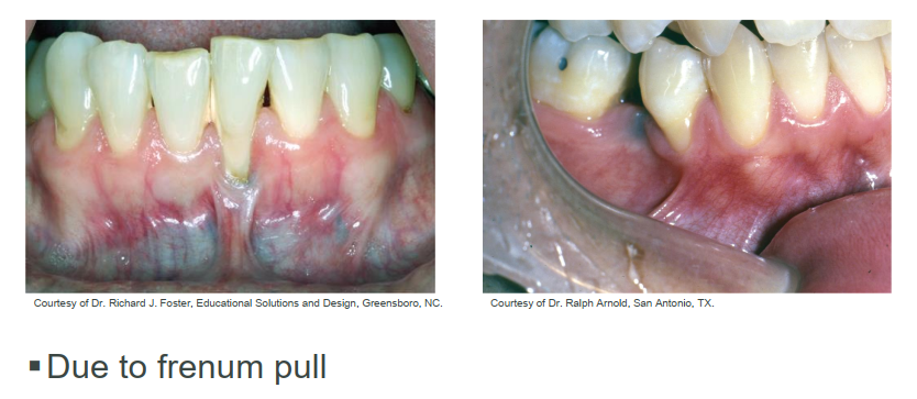 <p>frenum pull can cause gingival recession </p>