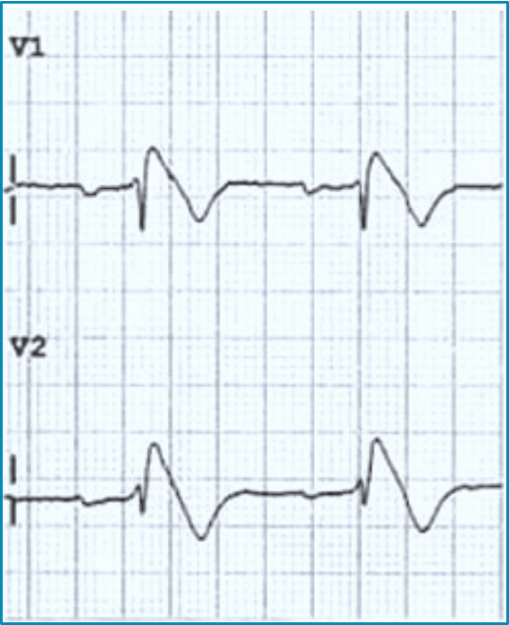 <p>What <strong>autosomal dominant</strong> condition is usually diagnosed in 5th decade (40s) &amp; associated with an increased risk of ventricular tachyarrhythmias &amp; sudden cardiac death?</p><p><em>*down sloping ST elevation in V1 &amp; V2</em></p>