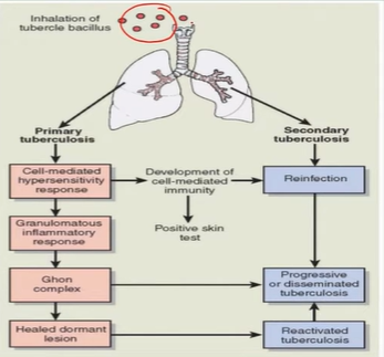 <p>Granuloma: ghon focus; macrophages that eat TB → dead tissue</p><ul><li><p>+ LN = Ghon complex</p></li></ul><p></p>