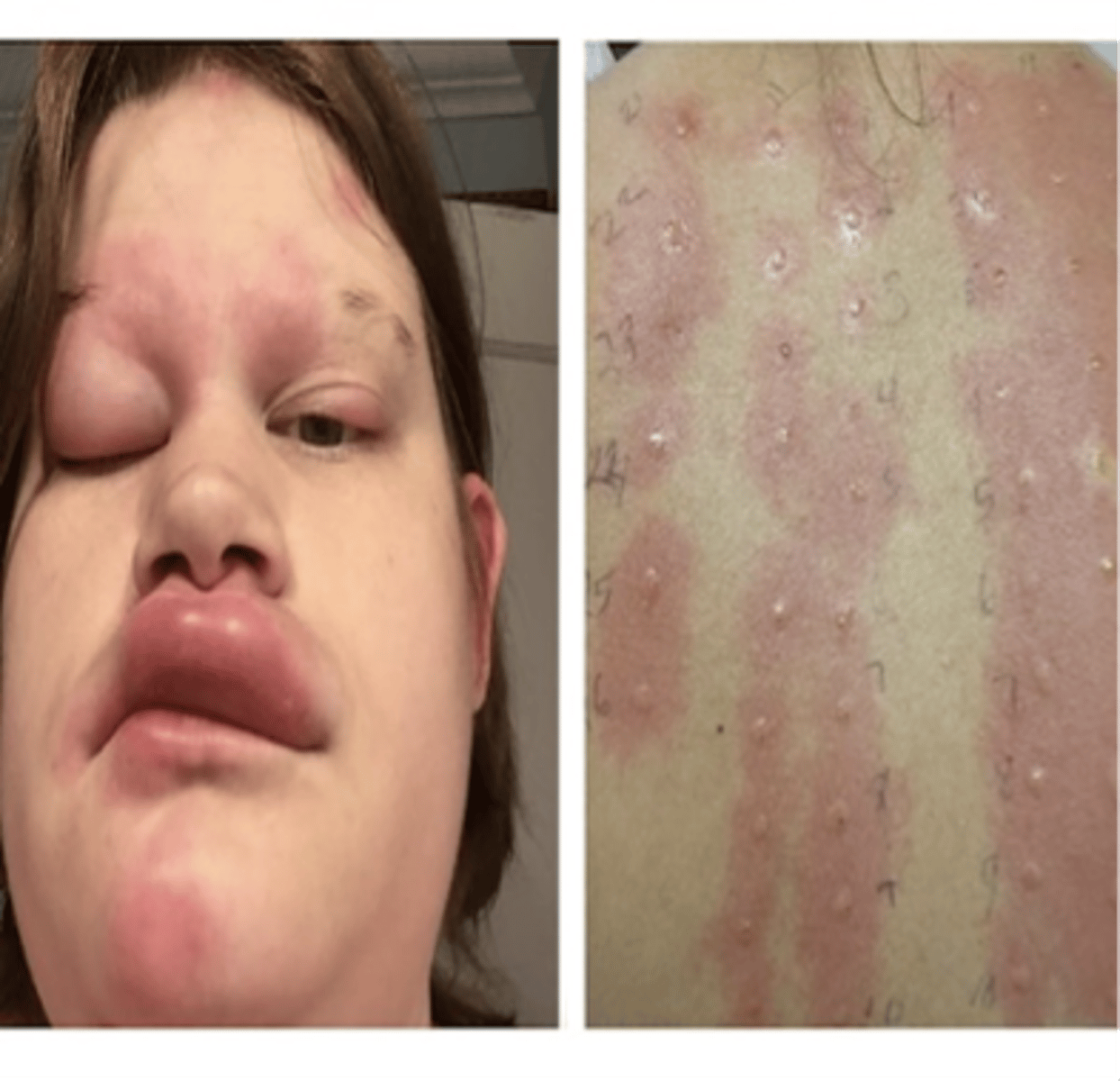 <p>•Direct physical damage</p><p>•Examples: cut, sprain</p><p>•Caustic chemicals</p><p>•Examples: acid, drain cleaner</p><p>•Ischemia (reduced blood flow) or infarction</p><p>•Allergic reactions</p><p>•Extremes of heat or cold</p><p>•Foreign bodies</p><p>•Examples: splinter, glass</p><p>•Infection</p>