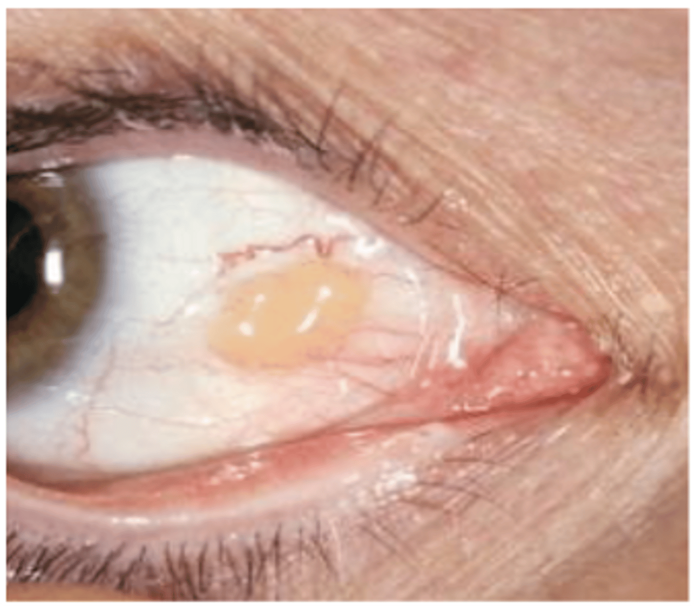 <p>name the conjuctival abnormality</p>