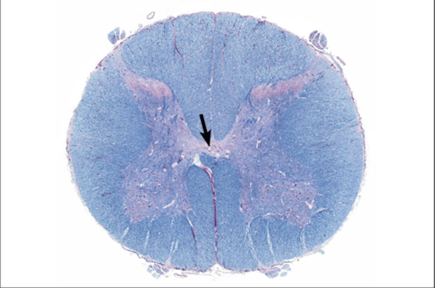 <p>center of gray commissure</p>