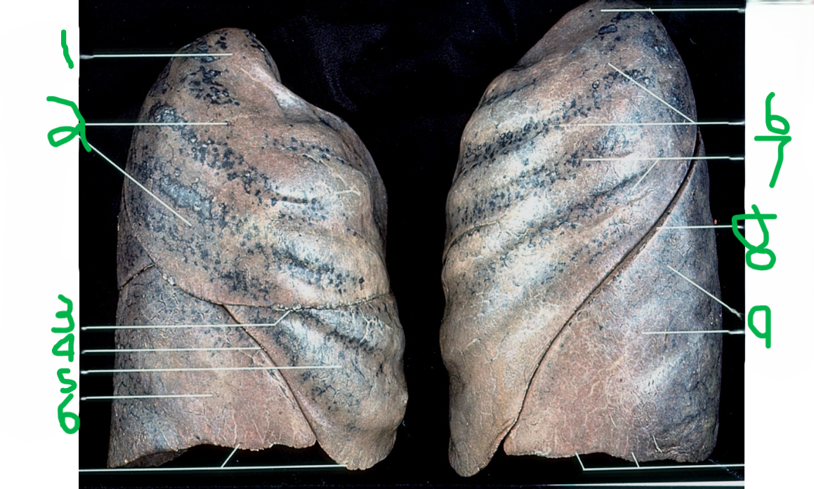 <p>Inferior lobe</p>