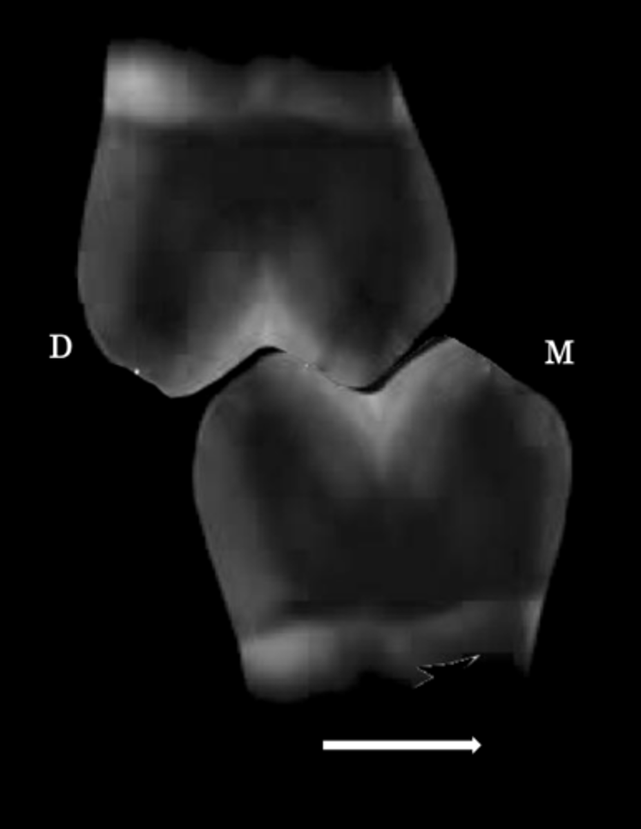 <p>Usually found at distal incline of maxillary cusps against mesial incline mandibular cusps</p>