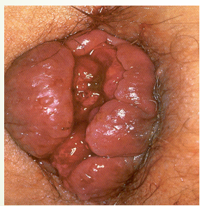 <p>Hemorrhoids will have a more linear appearance</p>