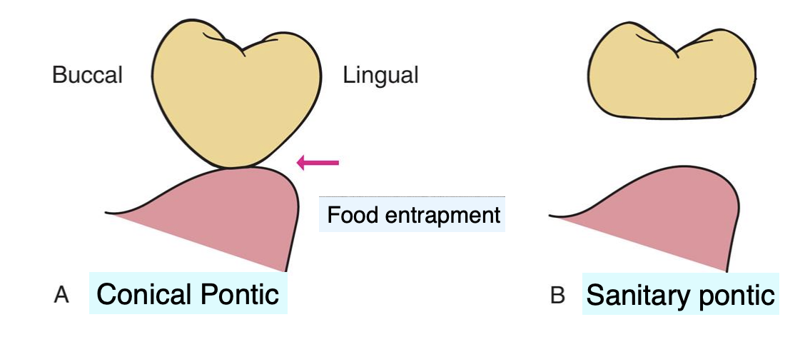 <p>sanitary pontic </p>