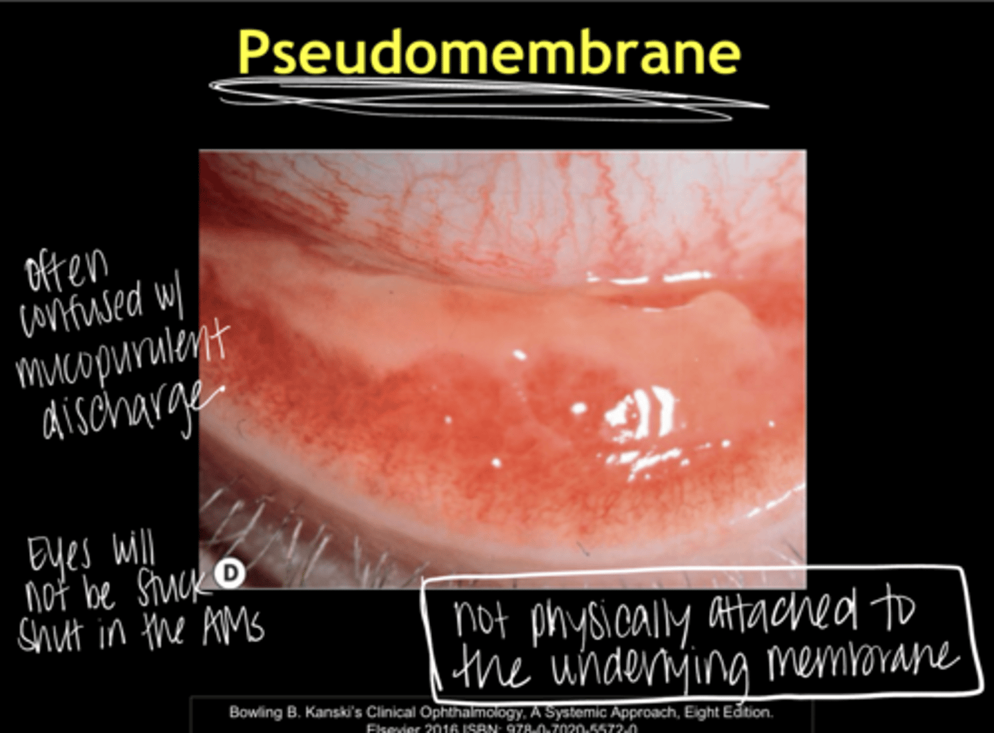 <p>What is a common finding of EKC that is confused with mucopurulent discharge?</p>