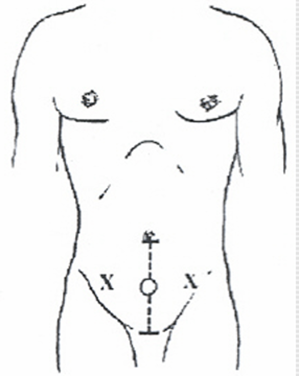 <p>o Avoid rectus sheath and vasculature</p><p>o Infraumbilical approach</p><p>o Left or right lower quandrants</p>