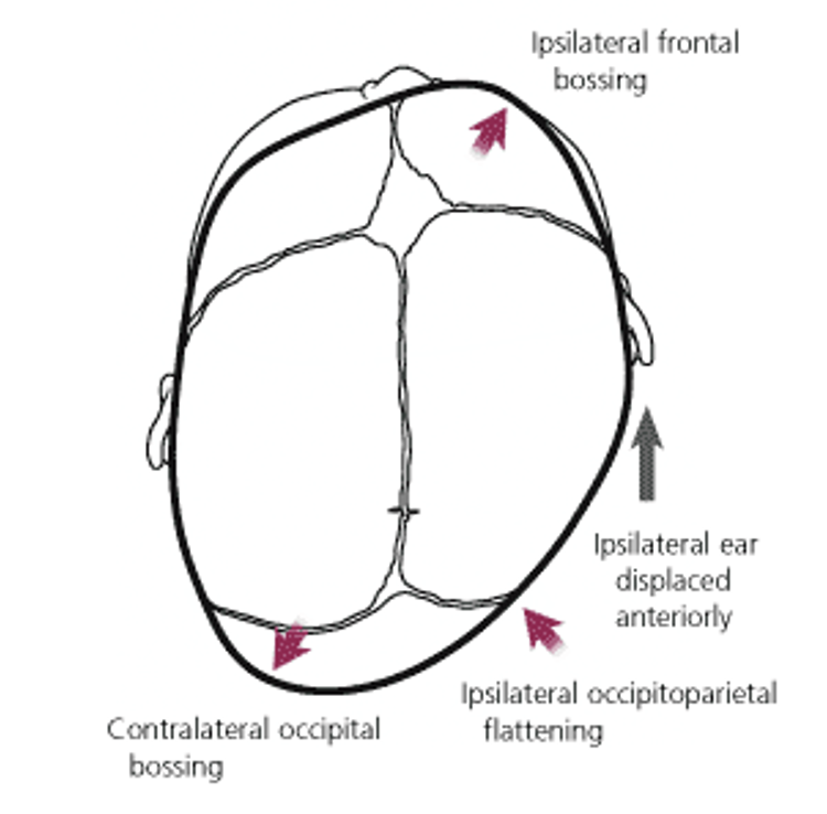 <p>Plagiocephaly </p>