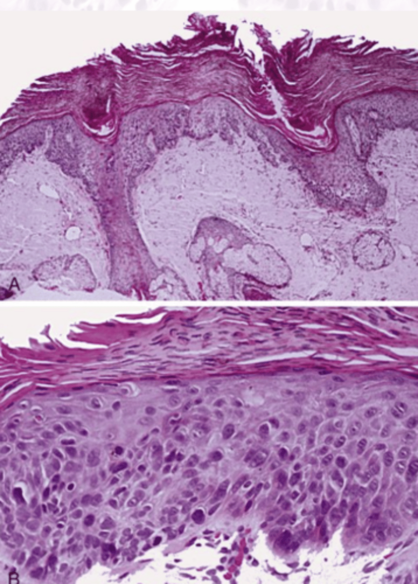 <p>These histology characteristics are indicative of what epithelial pathology?</p><p>Hyperkeratosis</p><p>Dysplasia</p><p>Solar Elastosis</p><p>Chronic inflammation</p>
