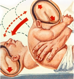 <p><strong>Abusive head trauma (ART) or shaken baby syndrome</strong></p>